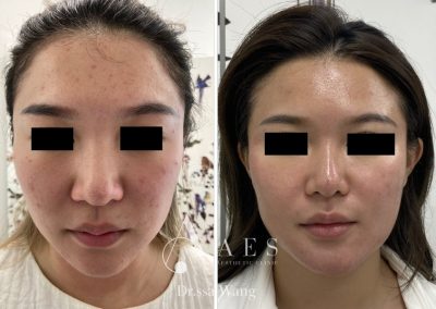 ACNE PRE POST