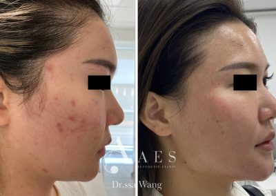 ACNE PRE POST