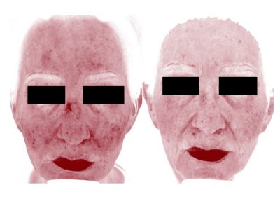 Aree rosse prima e dopo trattamento laser - Vista Frontale