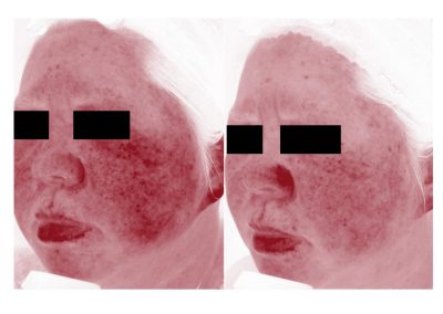 Aree rosse prima e dopo trattamento laser - Vista laterale