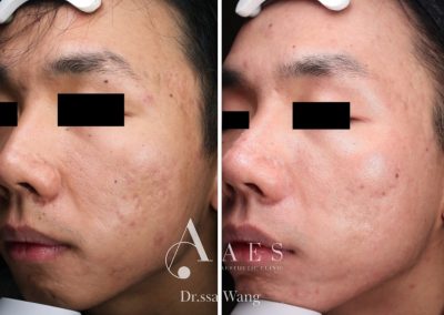 CICATRICI DA ACNE PRE POST