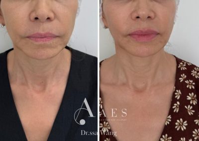 FILLER LABBRA PRE POST