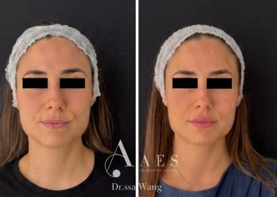 FILLER LABBRA PRIMA E DOPO