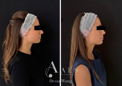 FILLER LABBRA PRIMA E DOPO