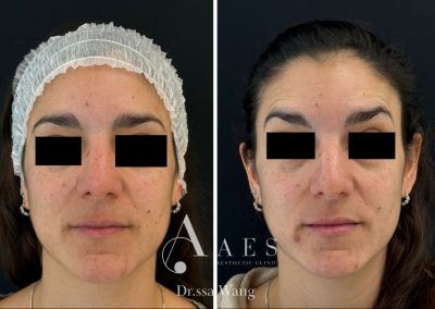 FILLER LABBRA Pre Post