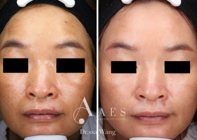 MELASMA PRE POST