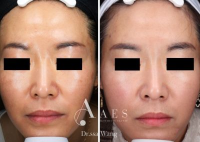 MELASMA PRE POST