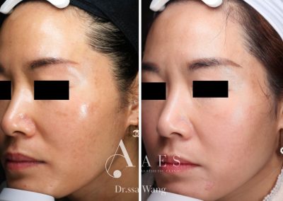 MELASMA PRE POST