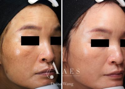 MELASMA PRE POST