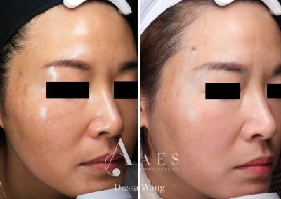 MELASMA PRE POST
