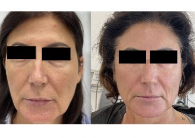 Ringiovanimento Viso Full Face a Padova