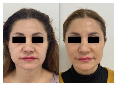 Ringiovanimento Full Face - Protocollo combinato In sei mesi