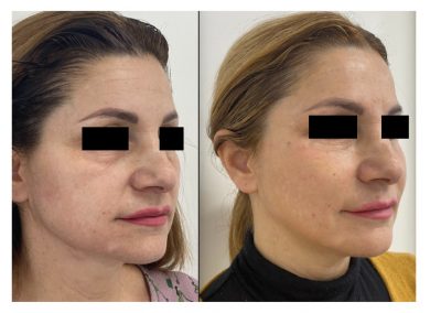 Ringiovanimento Full Face - Protocollo combinato In sei mesi