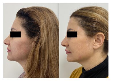 Ringiovanimento Full Face - Protocollo combinato In sei mesi