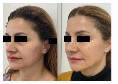 Ringiovanimento Full Face - Protocollo combinato In sei mesi