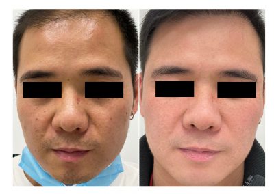 Trattamento per il ringiovanimento viso a Padova