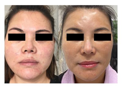 Trattamento per il ringiovanimento viso a Padova