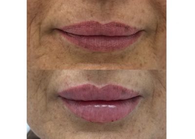 Aumento Volume Labbra