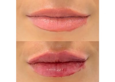 Aumento Volume Labbra