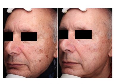 Eliminare cheratosi Padova