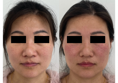 Eliminare occhiaie con Effetto Lifting a Padova