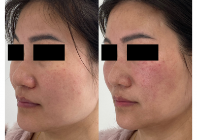 Eliminare occhiaie a Padova