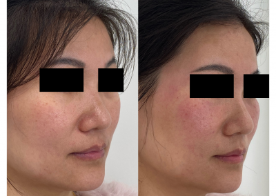 Eliminare occhiaie a Padova