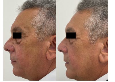 Eliminazione Fibromi