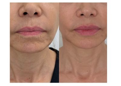 Filler Labbra prima e dopo