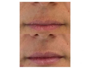 Filler Labbra prima e dopo
