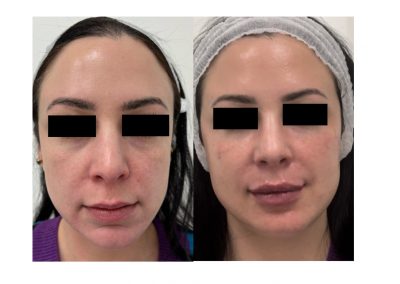 Filler Solco Lacrimale e Labbra