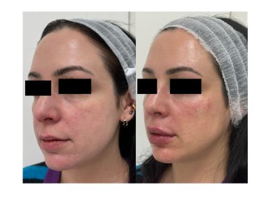 Filler Solco Lacrimale e Labbra