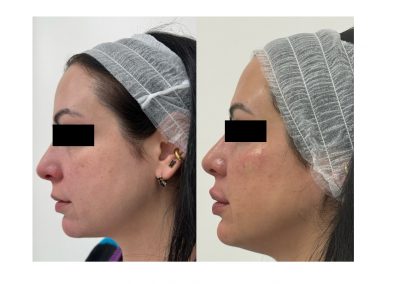 Filler Solco Lacrimale e Labbra