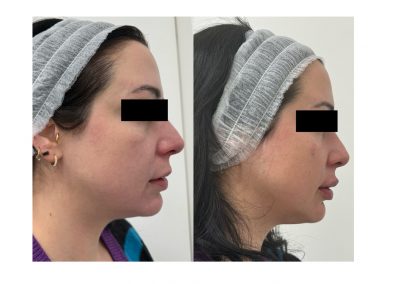 Filler Solco Lacrimale e Labbra