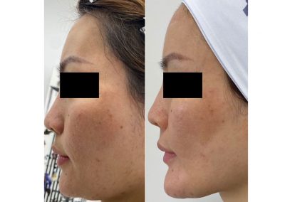 Foto prima e dopo trattamento Full Face - Ringiovanimento Viso