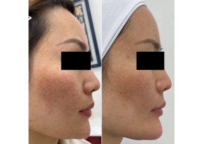 Foto prima e dopo trattamento Full Face - Ringiovanimento Viso