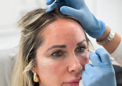 Trattamento Biostimolazione a Padova