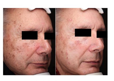 Rimozione cheratosi a Padova