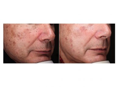 Rimozione cheratosi Padova