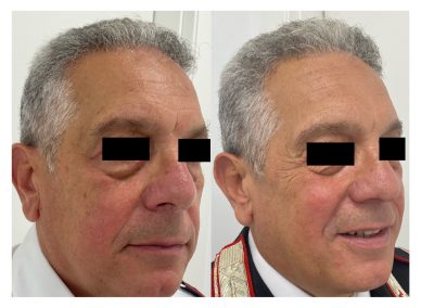 Rimozione Fibromi a Padova