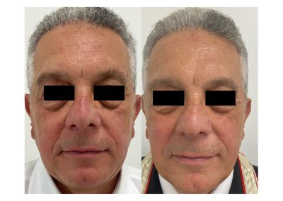 Rimozione Fibromi Padova