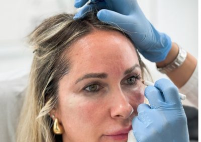 Ringiovanimento Cutaneo Radiesse® Padova