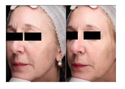 Ringiovanimento Full Face e Rimozione Macchie Senili