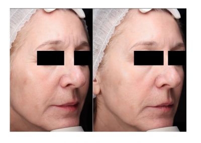 Ringiovanimento Full Face e Rimozione Macchie Senili