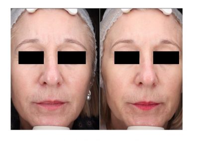 Ringiovanimento Full Face e Rimozione Macchie Senili