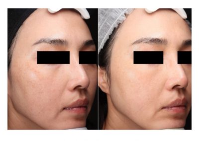 Ringiovanimento Laser Full Face e Macchie