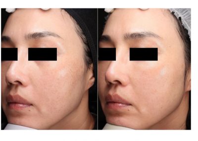 Ringiovanimento Laser Full Face e Macchie