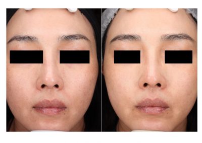 Ringiovanimento Laser Full Face e Macchie