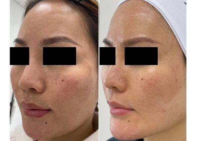 Ringiovanimento viso full face a Padova