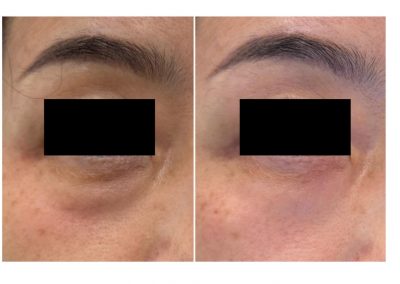 Risultato post Filler solco lacrimale